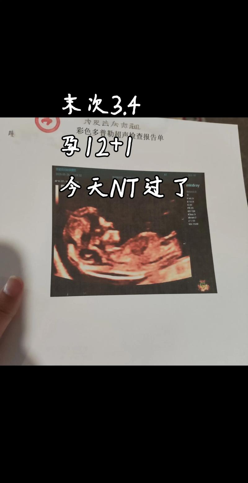 孕期NT检查到底需不需要空腹？有没有特殊情况要注意？-第2张图片-郑州医学网