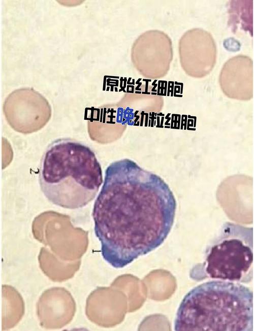 新生儿网织红细胞计数异常意味着什么？-第1张图片-郑州医学网