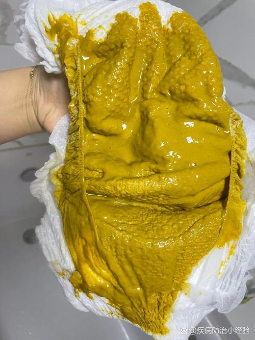 新生儿喝奶粉后出现水便分离，是奶粉不适应还是消化问题？-第1张图片-郑州医学网