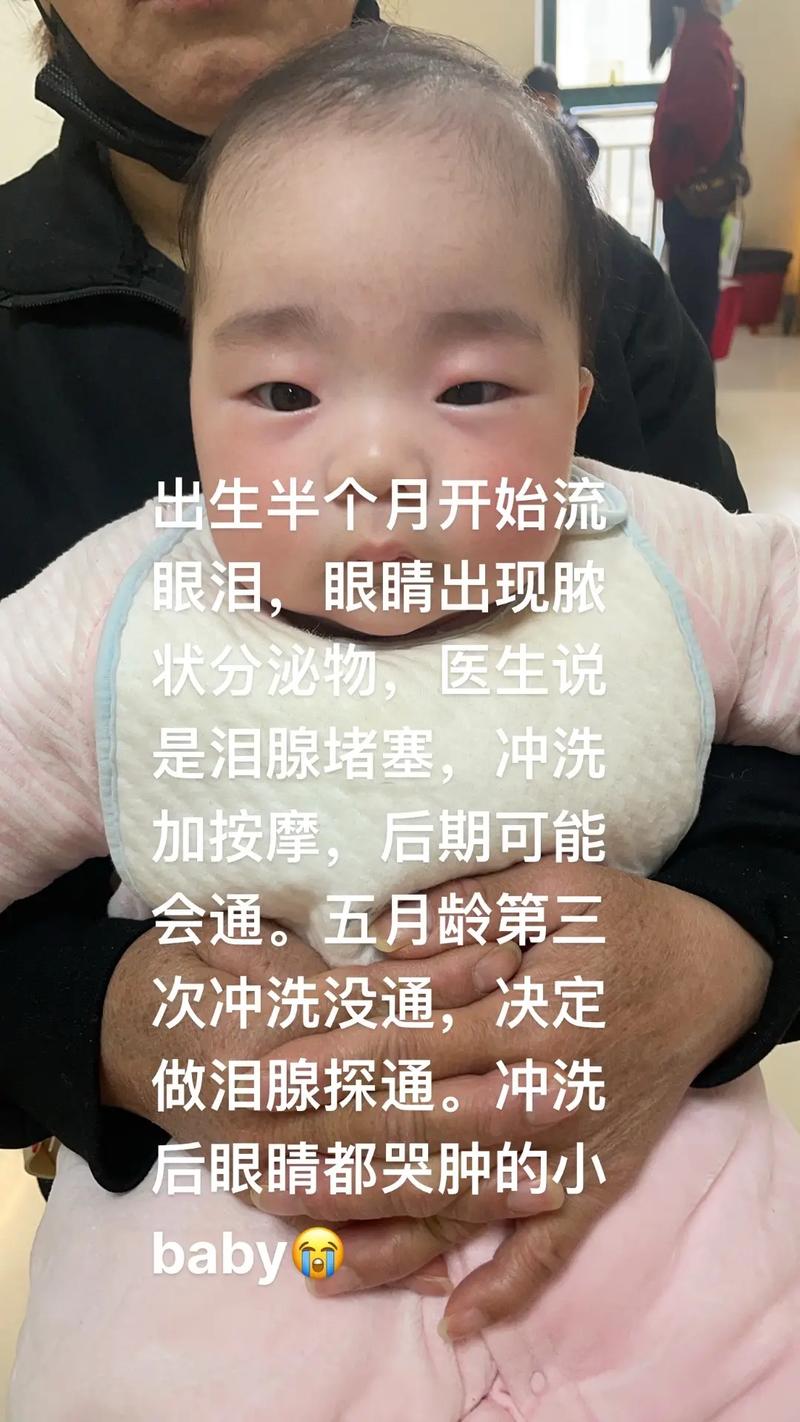 新生儿泪腺不通导致流出血水，这正常吗？需要如何处理？-第3张图片-郑州医学网