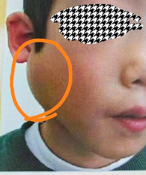 儿童腮腺炎初期症状有哪些典型表现？家长该如何早期识别与应对？-第1张图片-郑州医学网