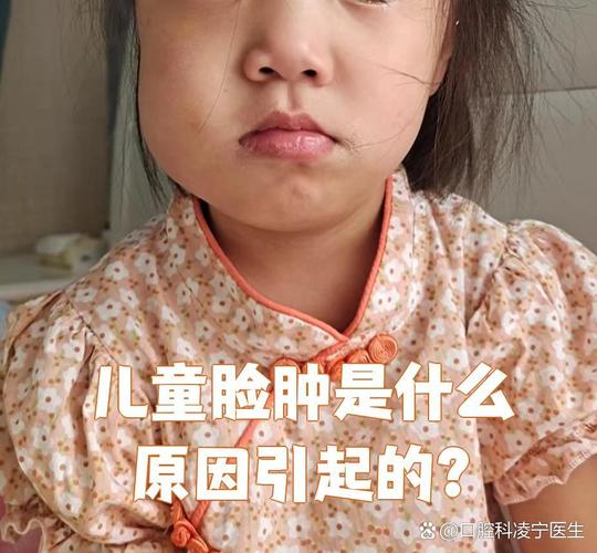儿童腮腺炎初期症状有哪些典型表现？家长该如何早期识别与应对？-第3张图片-郑州医学网