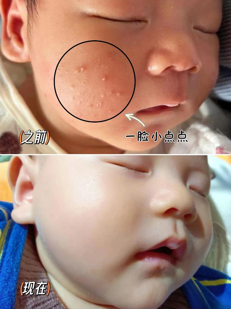 新生儿脸上长小粉刺是什么原因？需要处理吗？会影响皮肤健康吗？-第1张图片-郑州医学网