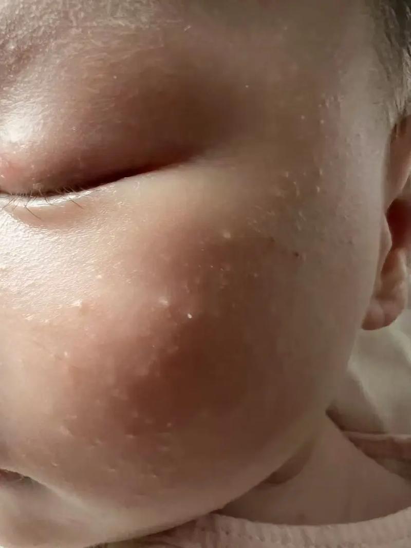 新生儿脸上长小粉刺是什么原因？需要处理吗？会影响皮肤健康吗？-第2张图片-郑州医学网