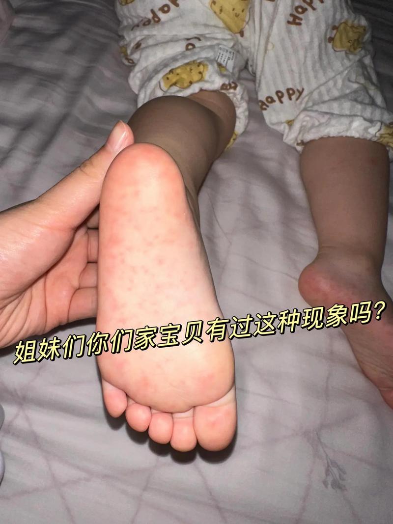 新生儿足底血苯丙氨酸偏高意味着什么?需要立即干预吗?-第1张图片-郑州医学网 新生儿足底血苯丙氨酸偏高意味着什么?需要立即干预吗?-第1张图片-郑州医学网