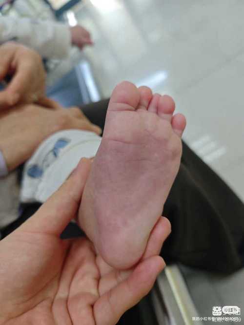 新生儿足底血苯丙氨酸偏高意味着什么?需要立即干预吗?-第2张图片-郑州医学网 新生儿足底血苯丙氨酸偏高意味着什么?需要立即干预吗?-第2张图片-郑州医学网