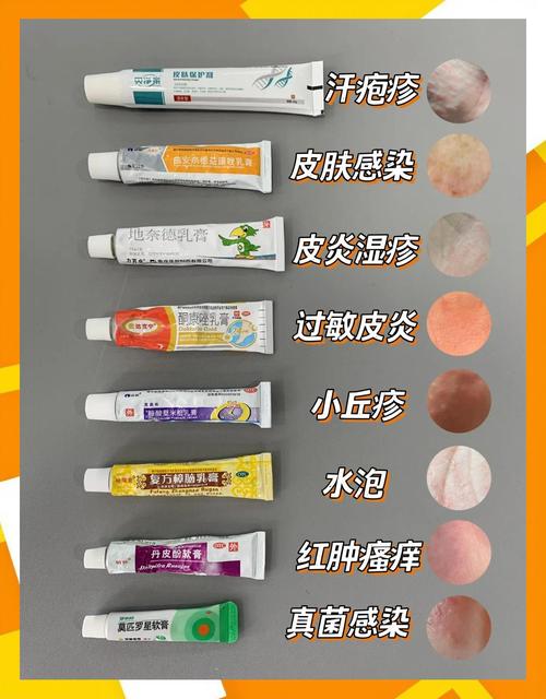 孕期汗疱疹用药安全吗？哪些外用药物不影响胎儿健康？-第1张图片-郑州医学网