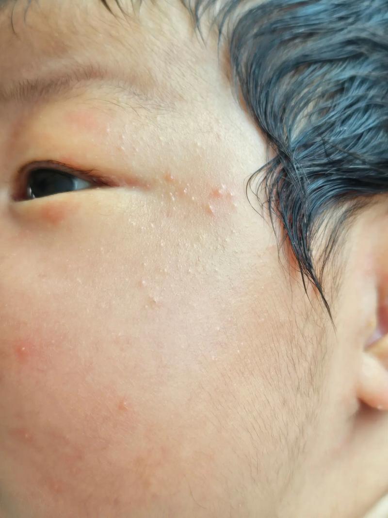 新生儿痤疮必须停母乳吗?不干预会自愈吗?-第1张图片-郑州医学网 新生儿痤疮必须停母乳吗?不干预会自愈吗?-第1张图片-郑州医学网