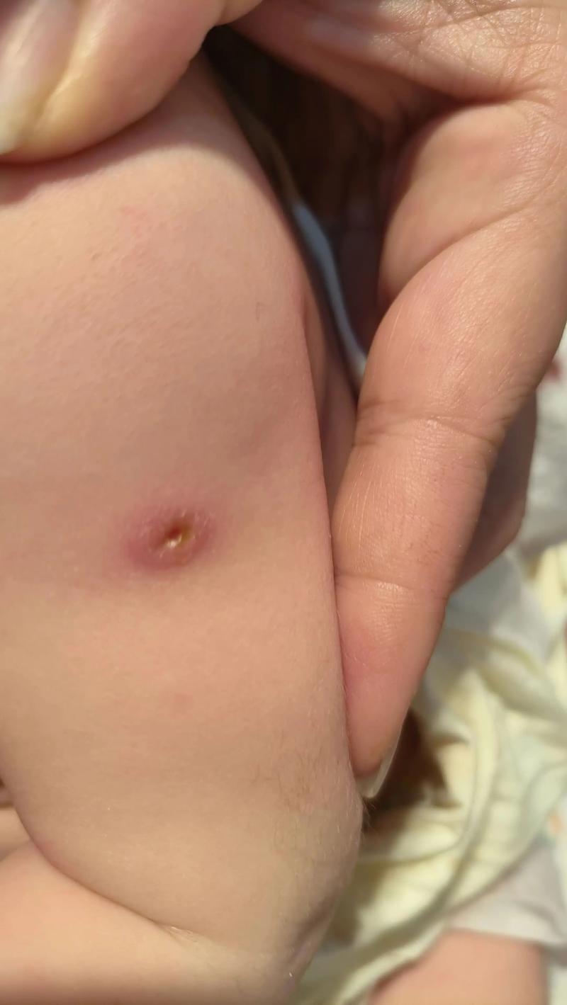 新生儿打预防针后伤口化脓了怎么办？需要处理吗？-第1张图片-郑州医学网