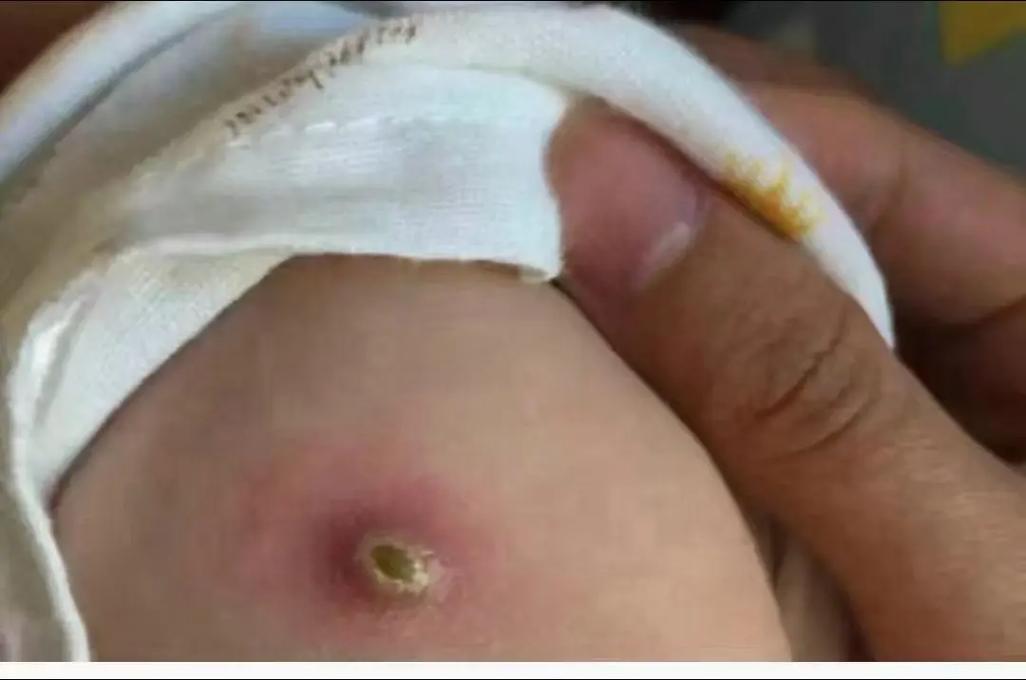 新生儿打预防针后伤口化脓了怎么办？需要处理吗？-第2张图片-郑州医学网