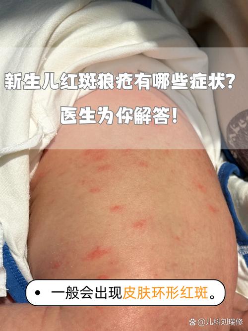 儿童红斑狼疮早期图片长啥样？这些皮肤信号家长千万别忽视！-第1张图片-郑州医学网