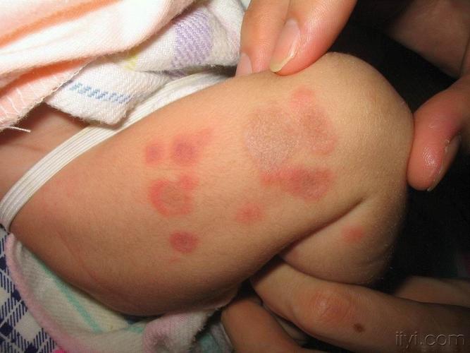 儿童红斑狼疮早期图片长啥样？这些皮肤信号家长千万别忽视！-第2张图片-郑州医学网