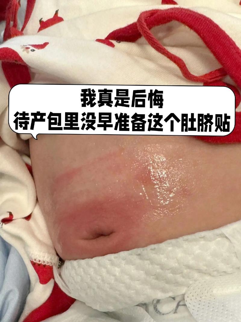 新生儿肚脐眼突出红肿是感染还是正常现象？该如何处理？-第3张图片-郑州医学网
