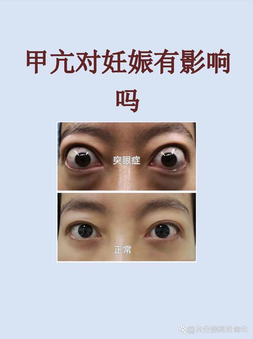 孕期甲亢会对胎儿发育及孩子未来健康造成哪些潜在风险？-第1张图片-郑州医学网