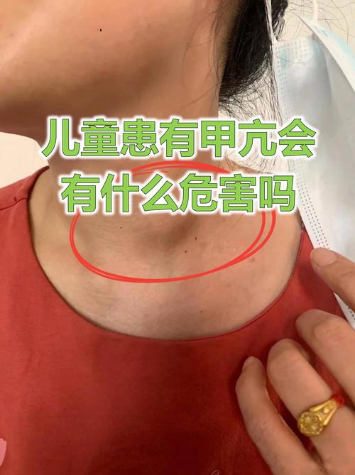 孕期甲亢会对胎儿发育及孩子未来健康造成哪些潜在风险？-第2张图片-郑州医学网