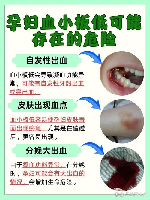孕期血小板减少的危害-第1张图片-郑州医学网 孕期血小板减少的危害-第1张图片-郑州医学网