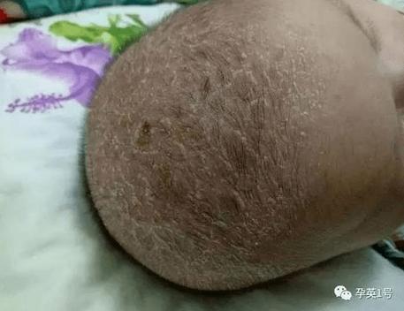 新生儿腋下白色分泌物是正常现象还是需要警惕的健康问题？-第1张图片-郑州医学网