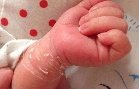 新生儿腋下白色分泌物是正常现象还是需要警惕的健康问题？-第2张图片-郑州医学网