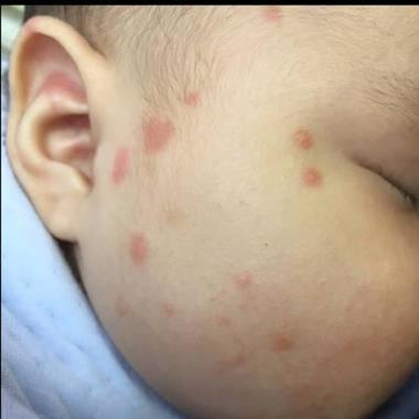 儿童轻微甲醛中毒有哪些容易被忽视的症状?-第2张图片-郑州医学网 儿童轻微甲醛中毒有哪些容易被忽视的症状?-第2张图片-郑州医学网