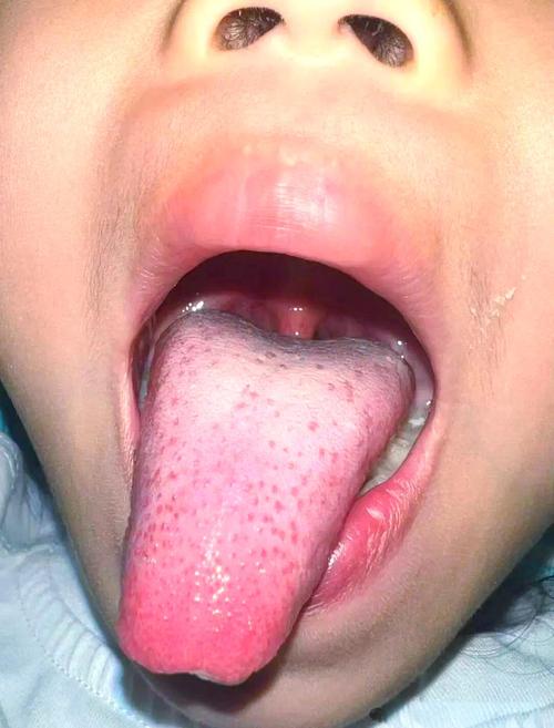 缺锌儿童舌头会出现哪些典型症状？附真实图片对比解析。-第1张图片-郑州医学网