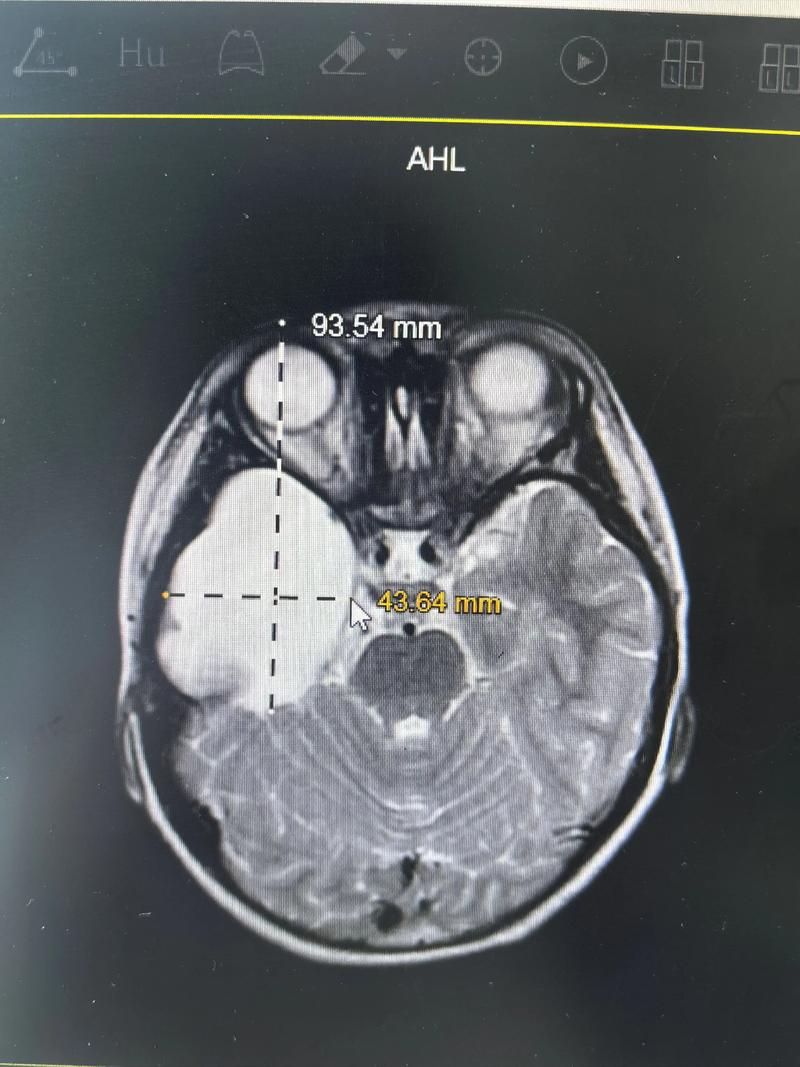新生儿脑部蛛网膜囊肿会自行消失吗？需要治疗吗？对发育有影响吗？-第1张图片-郑州医学网