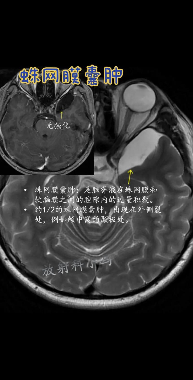 新生儿脑部蛛网膜囊肿会自行消失吗？需要治疗吗？对发育有影响吗？-第2张图片-郑州医学网