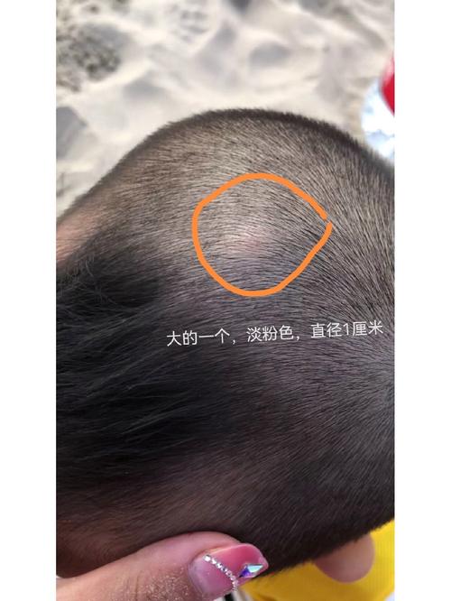 新生儿脑部蛛网膜囊肿会自行消失吗？需要治疗吗？对发育有影响吗？-第3张图片-郑州医学网