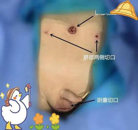 北京儿童医院隐睾手术风险大吗？术后恢复要注意什么？-第1张图片-郑州医学网