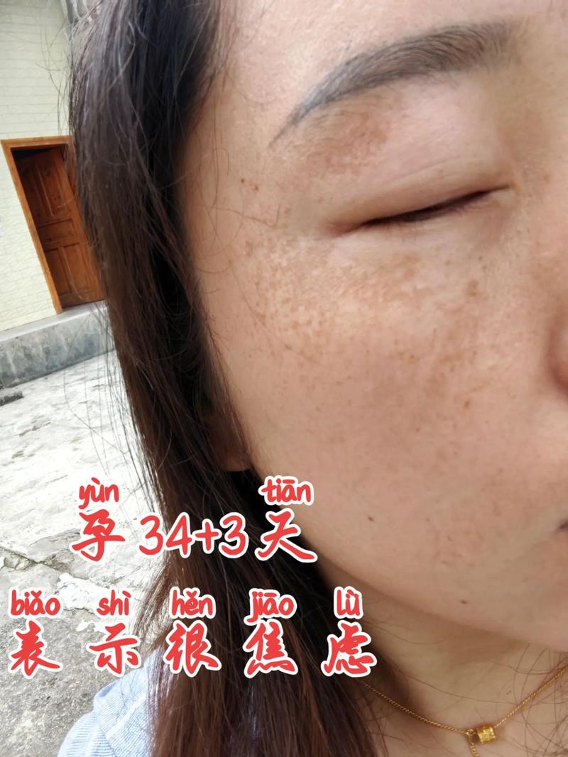 孕期色素沉淀难消退？有哪些安全有效的去除方法？-第2张图片-郑州医学网