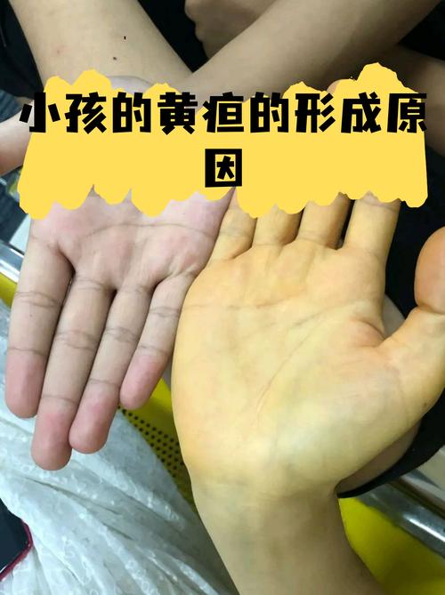 新生儿3天黄疸值18mg/dl需要立即干预吗？正常范围是多少？-第2张图片-郑州医学网