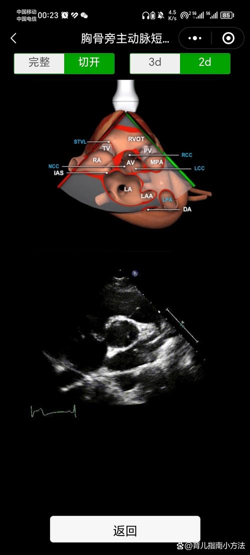 孕期胎儿心脏超声解剖，如何精准识别复杂结构异常？-第2张图片-郑州医学网