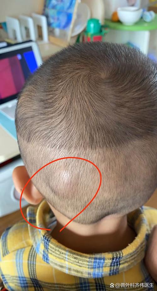 新生儿头上软包是什么原因？如何安全有效消除？需要警惕哪些异常情况？-第3张图片-郑州医学网