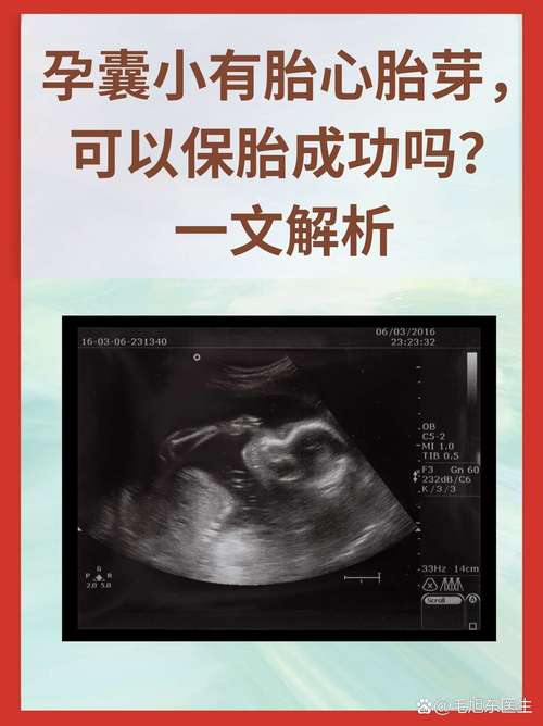 孕期cvt检查是什么-第1张图片-郑州医学网