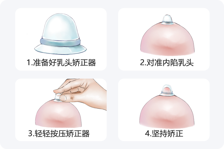 孕期乳头内陷不干预会影响哺乳吗？矫正方法安全吗？-第1张图片-郑州医学网
