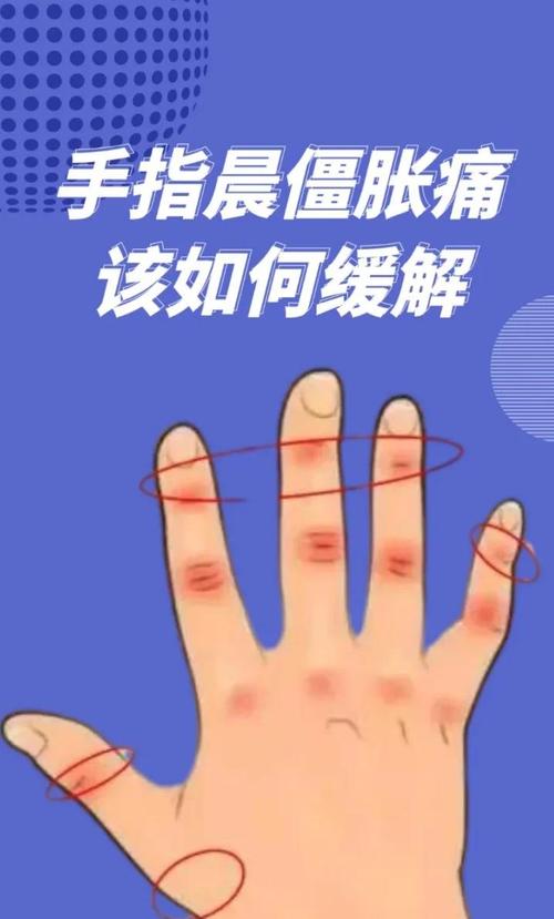 孕期手指肿胀怎么缓解？有哪些安全有效的办法能让手指轻松些？-第1张图片-郑州医学网
