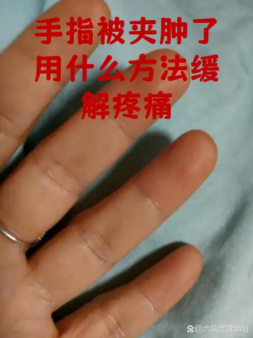 孕期手指肿胀怎么缓解？有哪些安全有效的办法能让手指轻松些？-第3张图片-郑州医学网