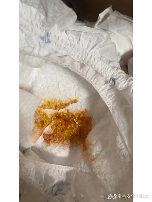 新生儿便秘大便带血丝是肛裂还是肠道问题？家长该如何应对与护理？-第2张图片-郑州医学网