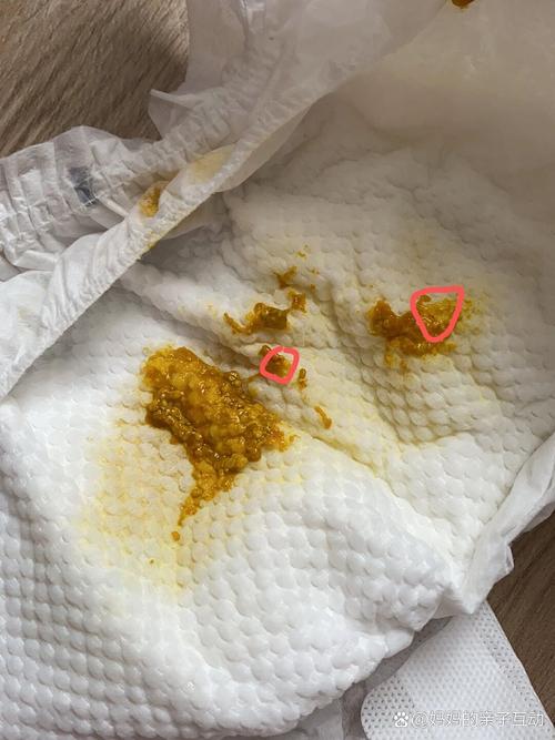 新生儿便秘大便带血丝是肛裂还是肠道问题？家长该如何应对与护理？-第1张图片-郑州医学网