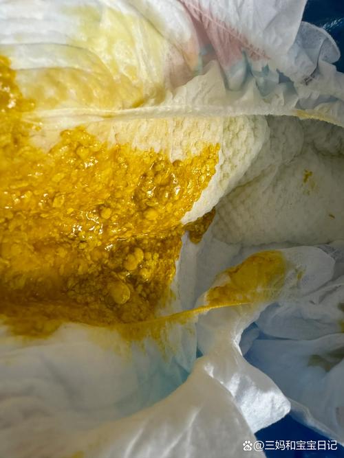 新生儿大便干燥肚子硬，是上火还是消化出了问题？-第1张图片-郑州医学网