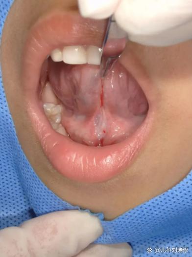 新生儿舌头总是往上翘是正常现象还是异常信号?需要干预吗?-第3张图片-郑州医学网 新生儿舌头总是往上翘是正常现象还是异常信号?需要干预吗?-第3张图片-郑州医学网