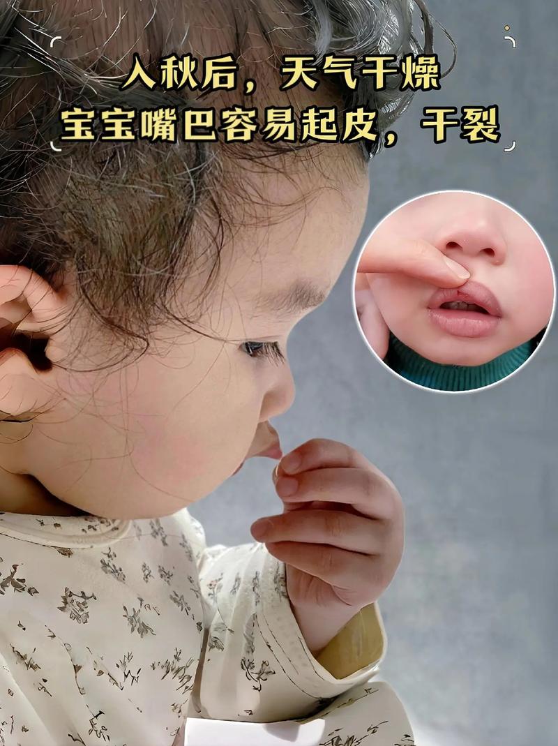 新生儿宝宝嘴唇干脱皮是缺水还是生病了？该怎么护理才正确？-第2张图片-郑州医学网