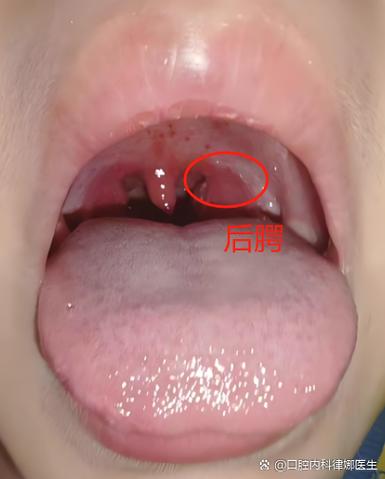 新生儿喉咙白色颗粒是正常现象吗？需要处理吗？-第2张图片-郑州医学网