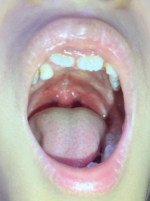 新生儿喉咙白色颗粒是正常现象吗？需要处理吗？-第1张图片-郑州医学网