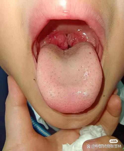 新生儿喉咙白色颗粒是正常现象吗？需要处理吗？-第3张图片-郑州医学网