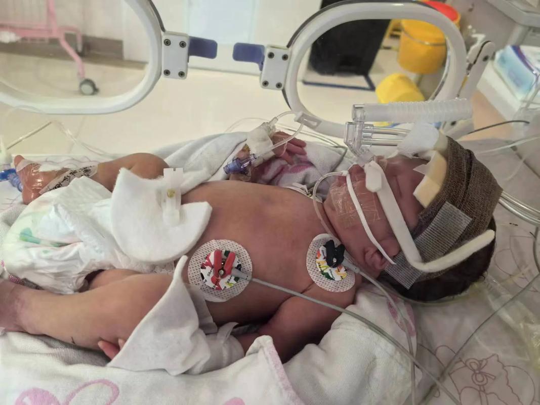 36周早产儿患肺炎，该如何科学护理才能降低风险？-第1张图片-郑州医学网