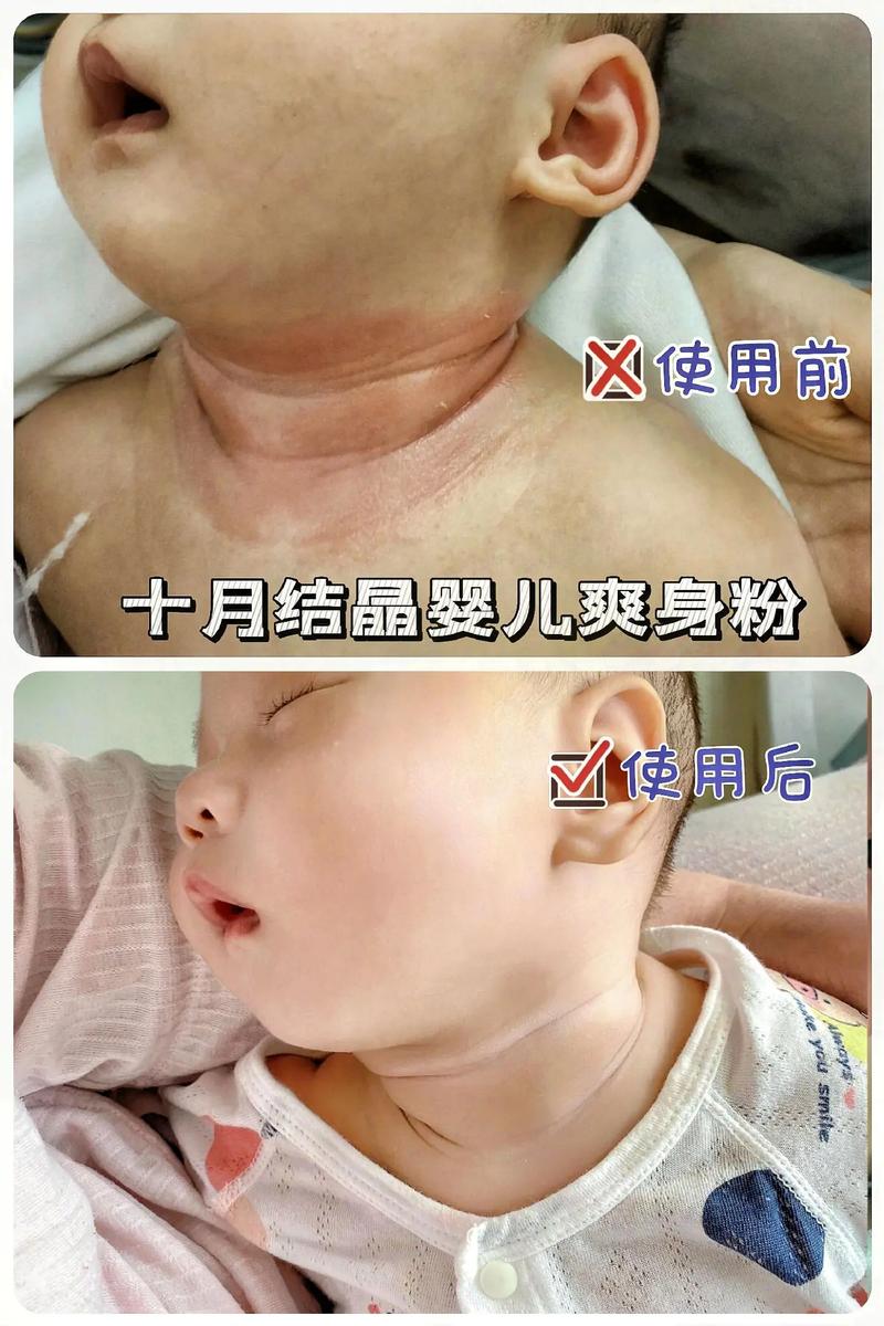 新生儿脖子褶皱处总淹红？怎么清洁护理才不伤娇嫩皮肤？-第2张图片-郑州医学网