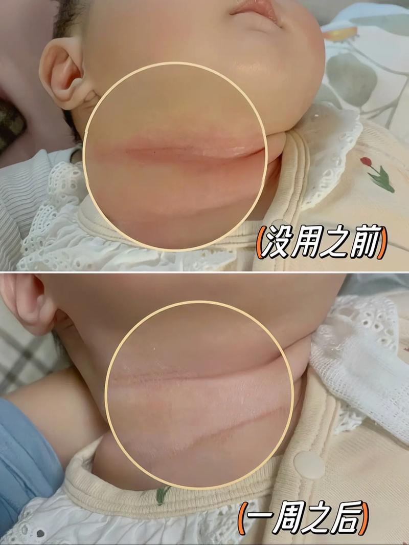 新生儿脖子褶皱处总淹红？怎么清洁护理才不伤娇嫩皮肤？-第3张图片-郑州医学网