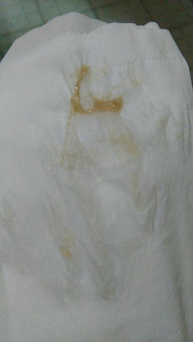 怀孕期间白带像豆腐渣是感染了吗？对胎儿有影响吗？-第3张图片-郑州医学网