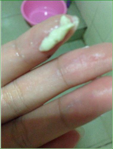 怀孕期间白带像豆腐渣是感染了吗？对胎儿有影响吗？-第1张图片-郑州医学网