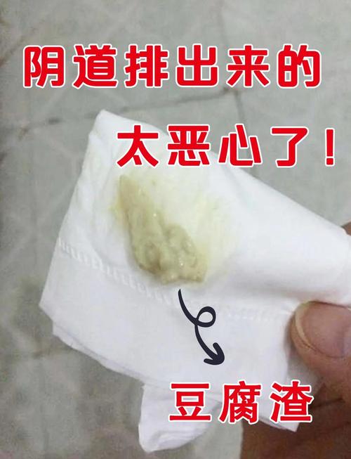 怀孕期间白带像豆腐渣是感染了吗？对胎儿有影响吗？-第2张图片-郑州医学网